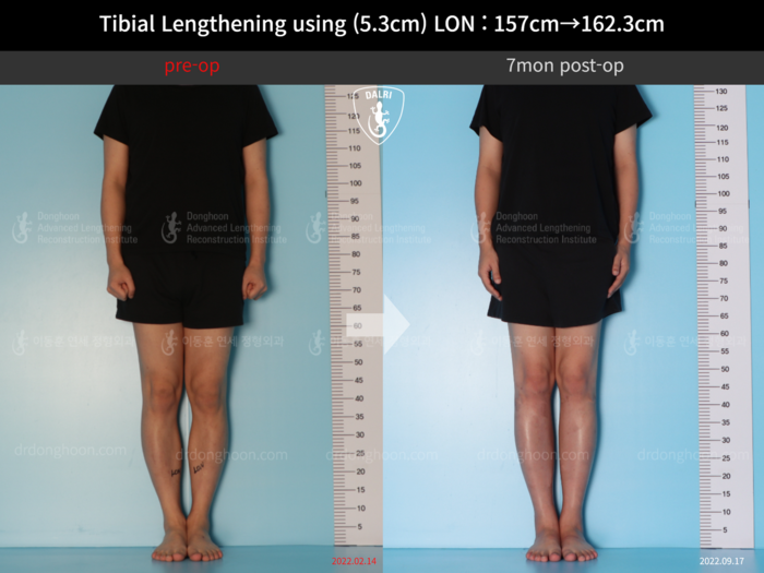 Tibial lengthening, 5.3 cm gained