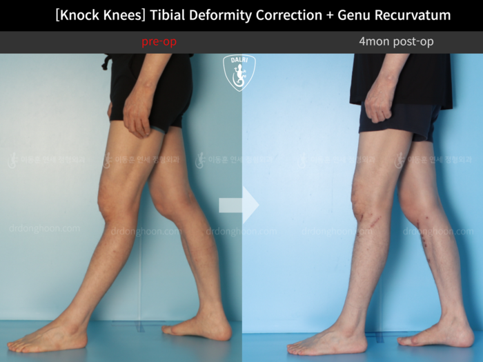 Tibial lengthening