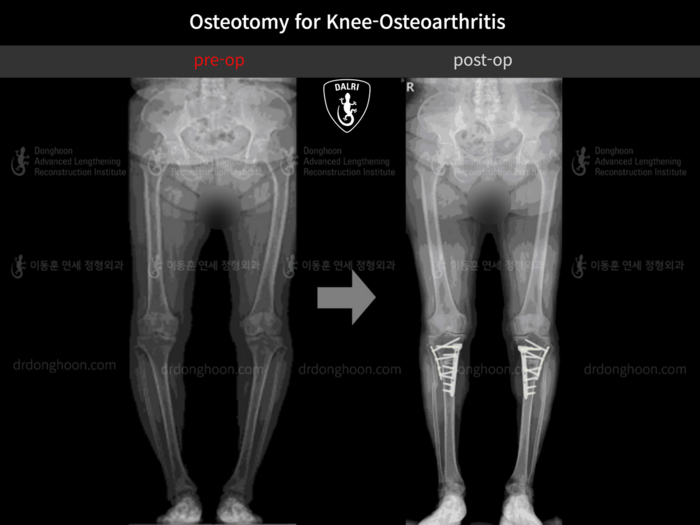 Osteotomy for knee osteoarthritis