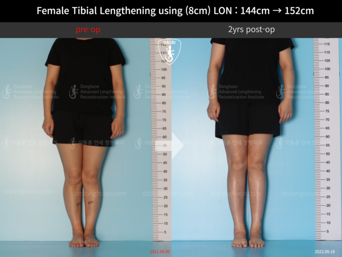 Tibial lengthening, 8 cm gained