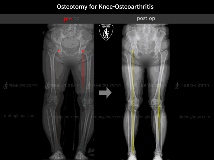 Osteotomy for knee osteoarthritis