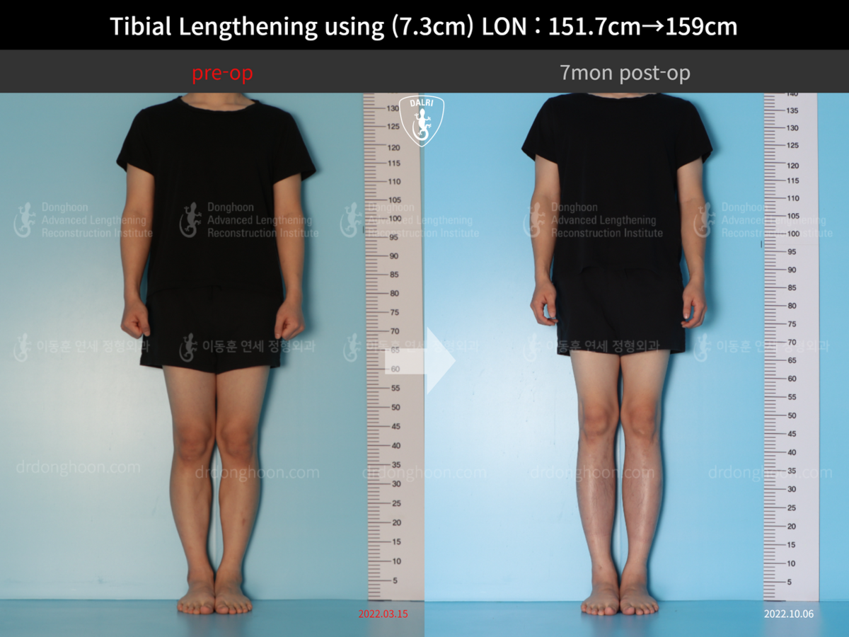 Tibial Lengthening Using (7.3cm) LON : 151.7cm→159cm : 7mon Post-op ...