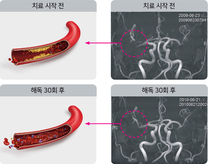 탈라킬레이션 혈관 청소로 동맥경화 고지혈증 치료 및 예방 10