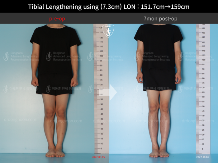 Tibial lengthening, 7.3 cm gained