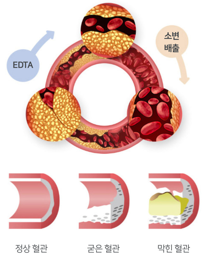 탈라킬레이션 혈관 청소로 동맥경화 고지혈증 치료 및 예방 9
