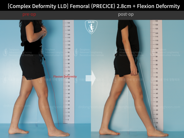 Femoral lengthening