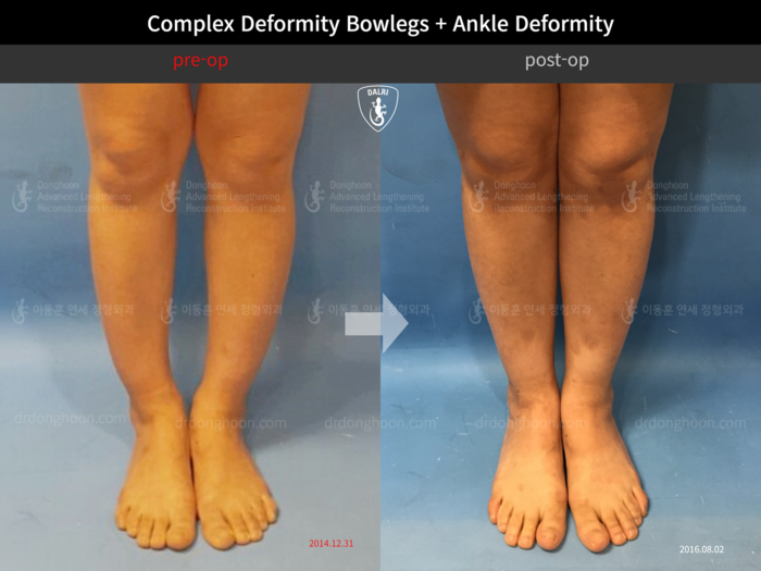 Foot & ankle deformity