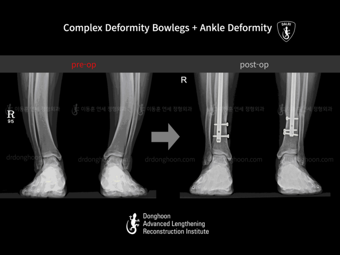 Foot & ankle deformity