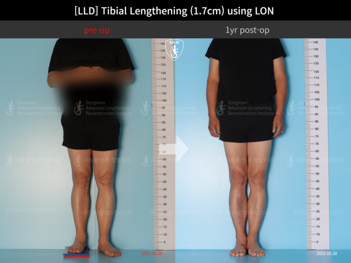ยืดกระดูกหน้าแข้ง เพิ่มขึ้น 1.7 ซม.