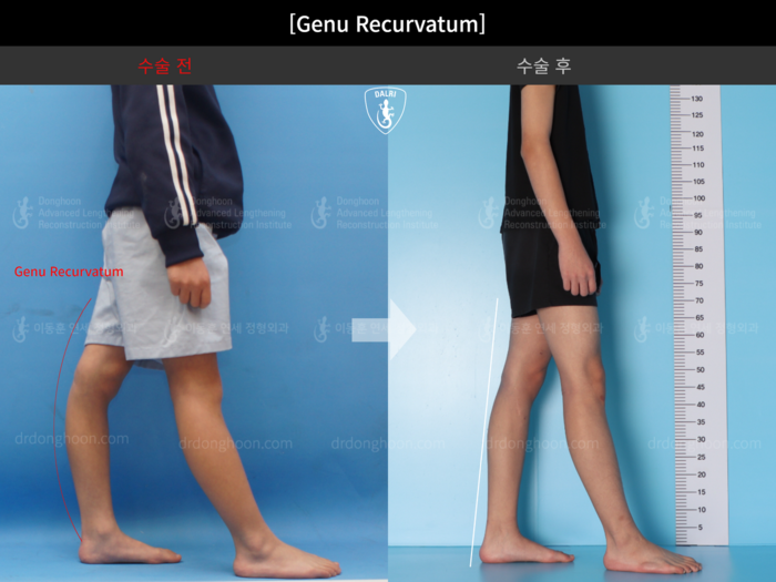 Complex & post-trauma deformity before and after radiograph example 2