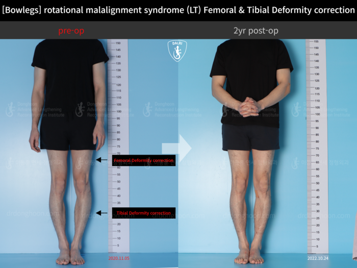 Femoral + tibial lengthening