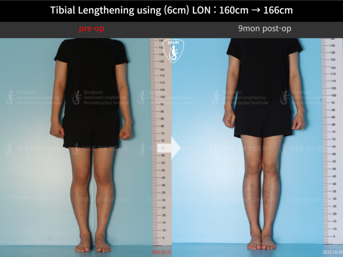 Tibial lengthening, 6 cm gained