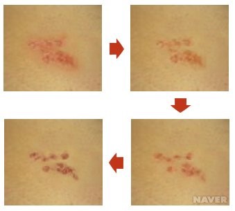 <출처: 네이버 지식백과, 서울대학교병원 의학정보>