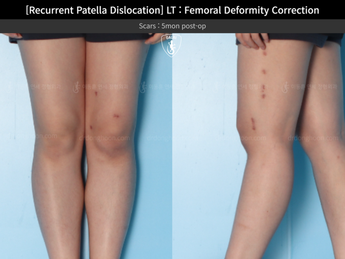 Femoral lengthening