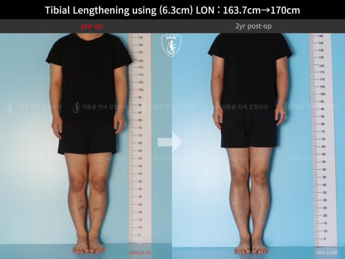 Tibial lengthening, 6.3 cm gained