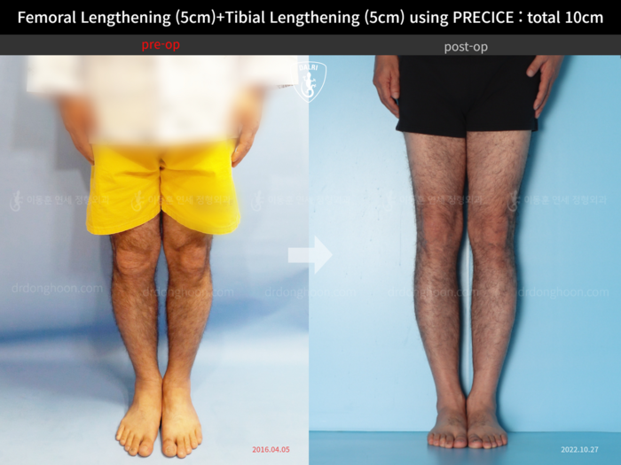 Femoral + tibial lengthening, 5 cm gained