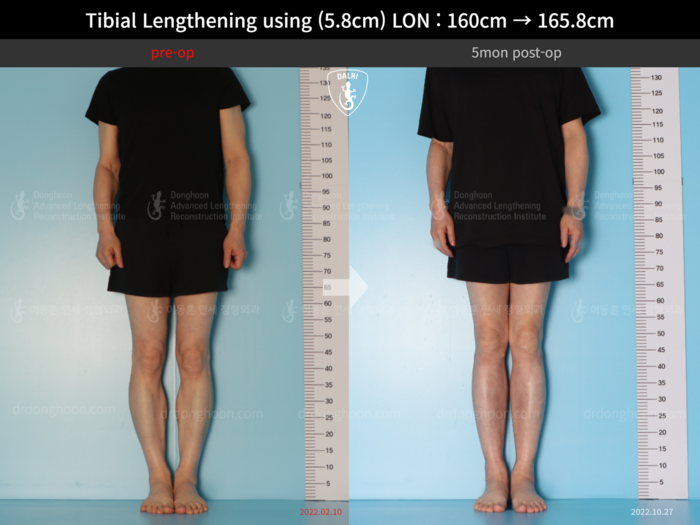Tibial lengthening, 5.8 cm gained