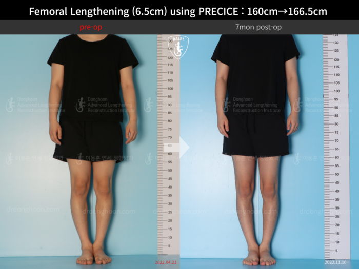 Femoral lengthening, 6.5 cm gained