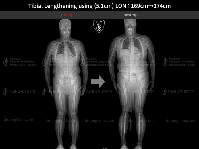 Tibial lengthening, 5.1 cm gained