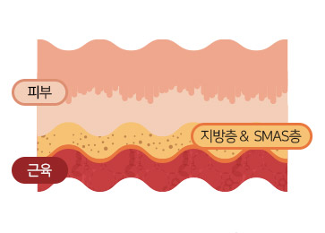 근육과 피부가 SMAS(섬유근막층)에 의해<br>연결된 상태로 근육수축으로 인해 <br>피부도 겹치면서 주름진 상태