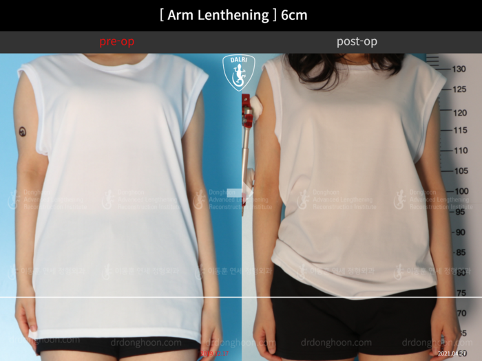 Arm lengthening