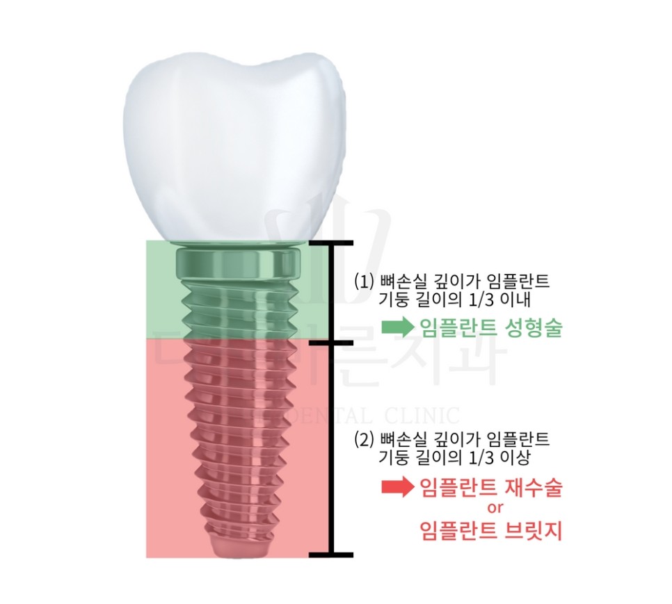 복잡한 전체임플란트, 틀니 종류 이거 하나로 정리합니다. : 김원장 칼럼, image size:966x869
