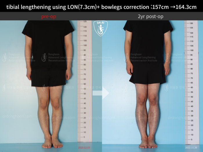 ยืดกระดูกหน้าแข้ง เพิ่มขึ้น 7.3 ซม.