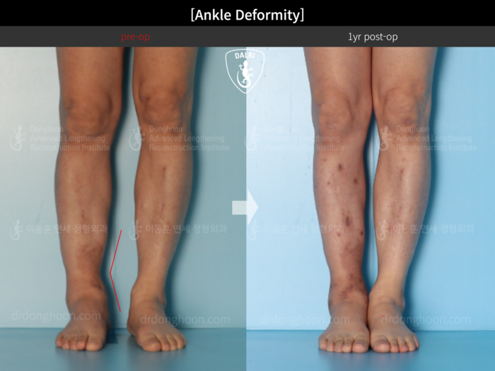 Arm, foot & ankle before and after radiograph example 3