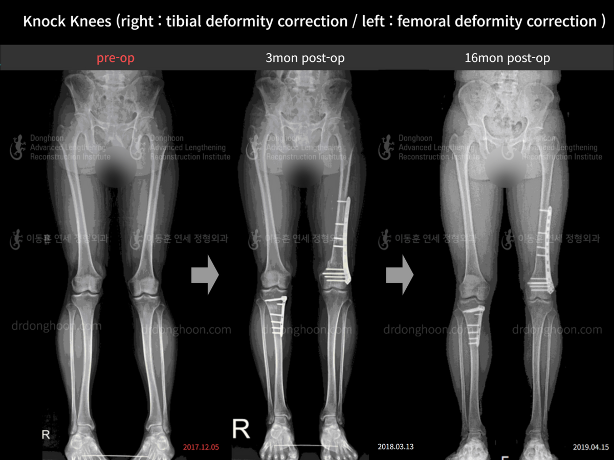 Knock Knees (right tibial deformity correction / left femoral