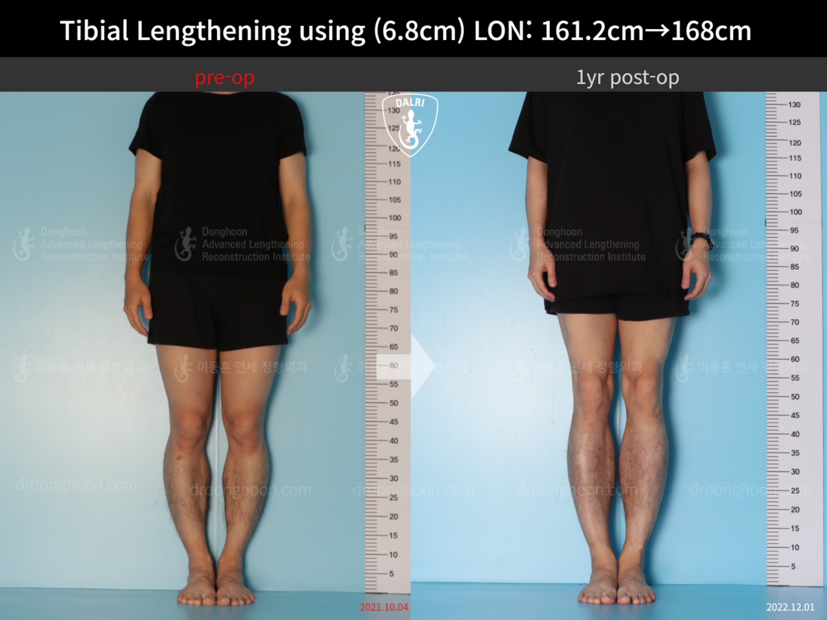 Tibial Lengthening Using (6.8cm) LON: 161.2cm→168cm : 1yr Post-op ...