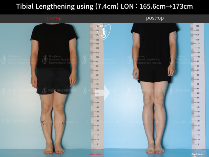 Tibial lengthening, 7.4 cm gained