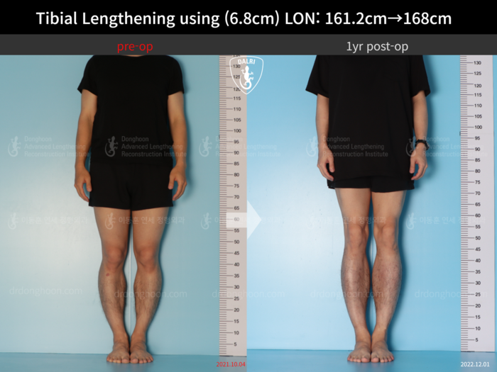 Tibial lengthening, 6.8 cm gained