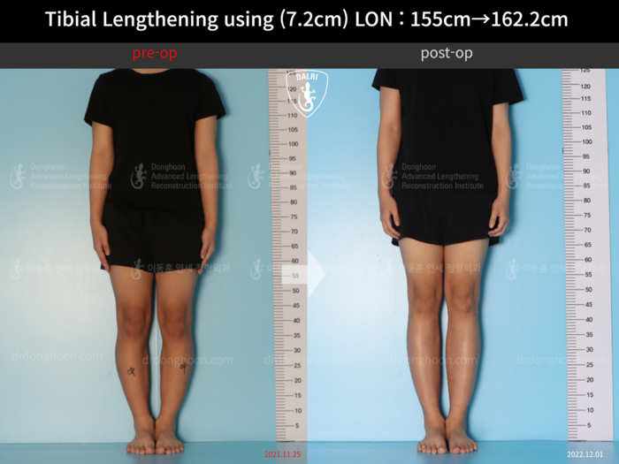 Tibial lengthening, 7.2 cm gained