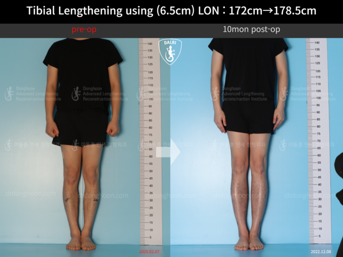 Tibial lengthening, 6.5 cm gained