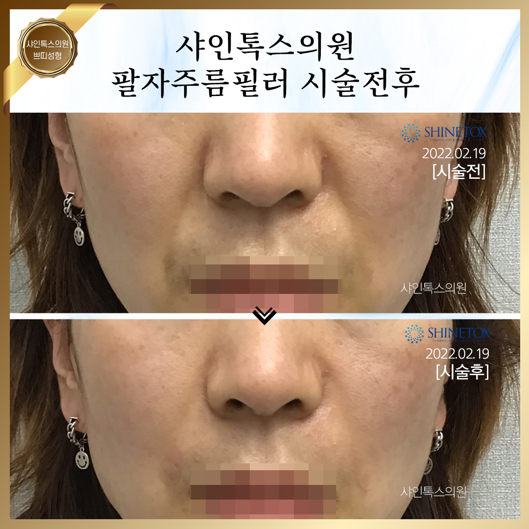 팔자주름필러_시술전후_1