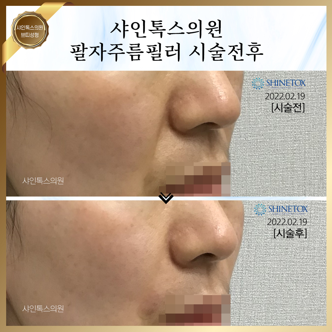 팔자주름필러_시술전후_2