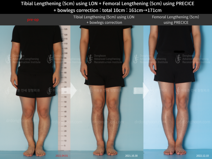 Femoral + tibial lengthening, 5 cm gained