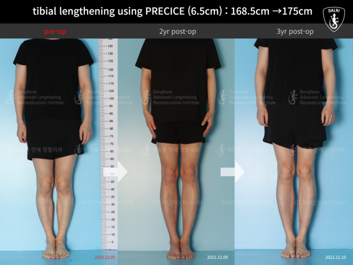 ยืดกระดูกหน้าแข้ง เพิ่มขึ้น 6.5 ซม.