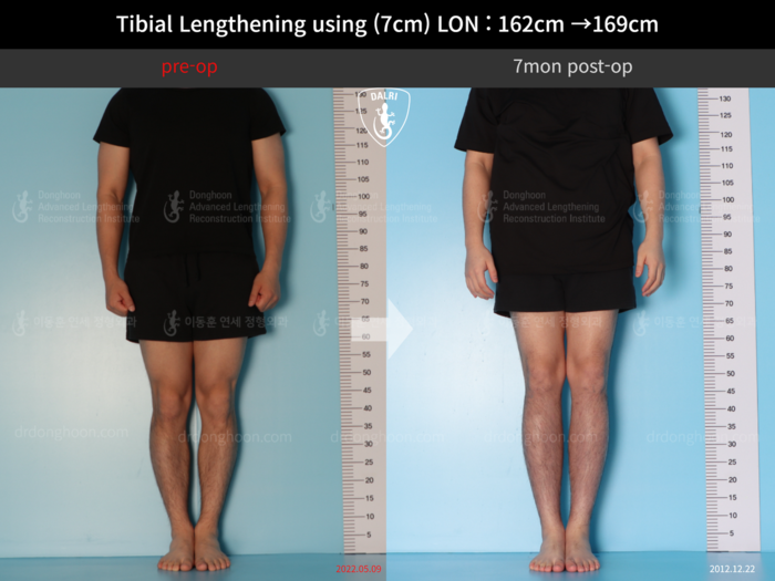 Tibial lengthening, 7 cm gained