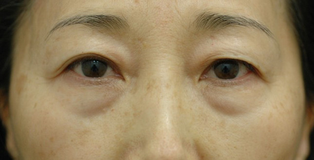 하안검수술과 눈밑지방재배치 중 선택이 필요한 5,60대