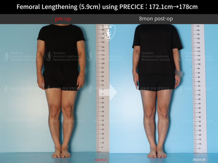 Femoral Lengthening (5.9cm) using PRECICE : 172.1cm→178cm : 8mon post-op