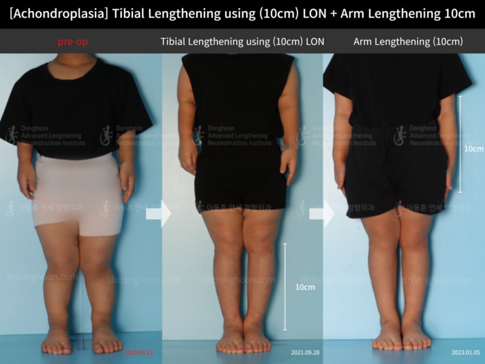 ยืดกระดูกหน้าแข้ง เพิ่มขึ้น 10 ซม.