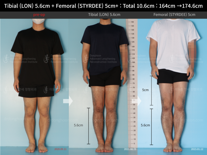 Femoral + tibial lengthening