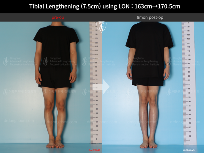 Tibial lengthening, 7.5 cm gained