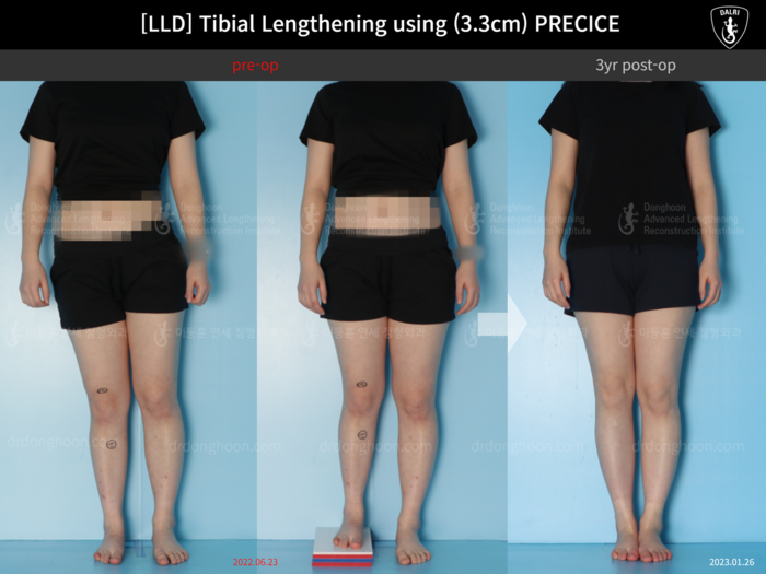 ยืดกระดูกหน้าแข้ง เพิ่มขึ้น 3.3 ซม.
