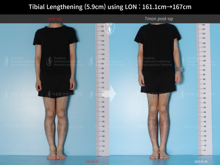 Tibial lengthening, 5.9 cm gained