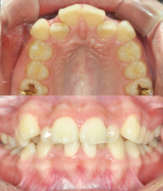 Case1. 돌출입 교정(Before)