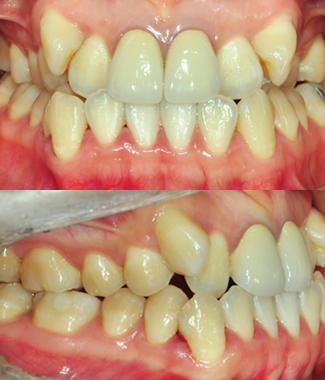 Case4. 덧니 교정(Before)