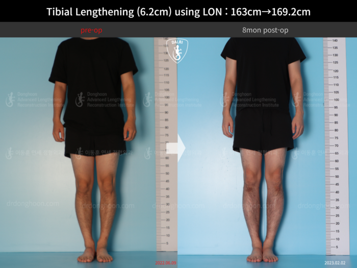 Tibial lengthening, 6.2 cm gained