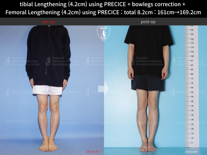 ยืดทั้งต้นขาและหน้าแข้ง เพิ่มขึ้น 4.2 ซม.
